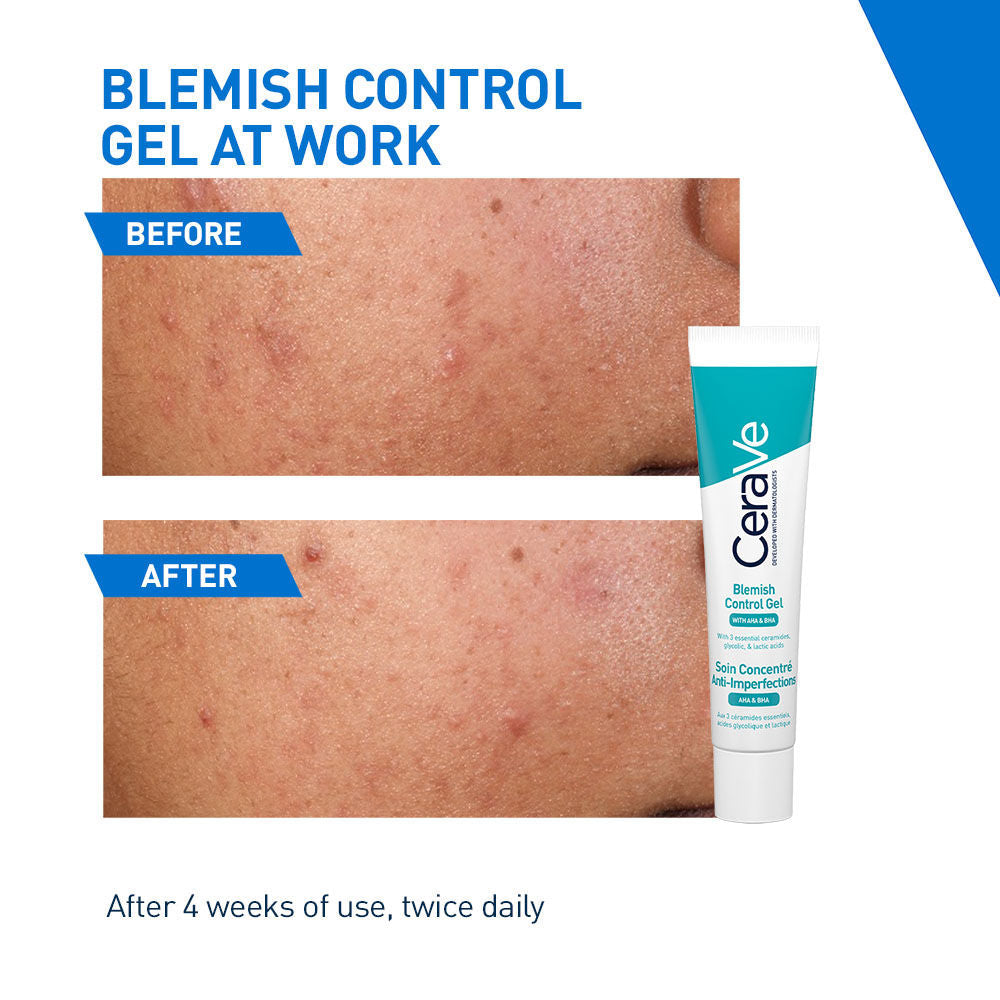 Blemish Control Gel with 2% Salicylic Acid, AHA & Niacinamide for Acne Spot Treatment(40ml) CeraVe